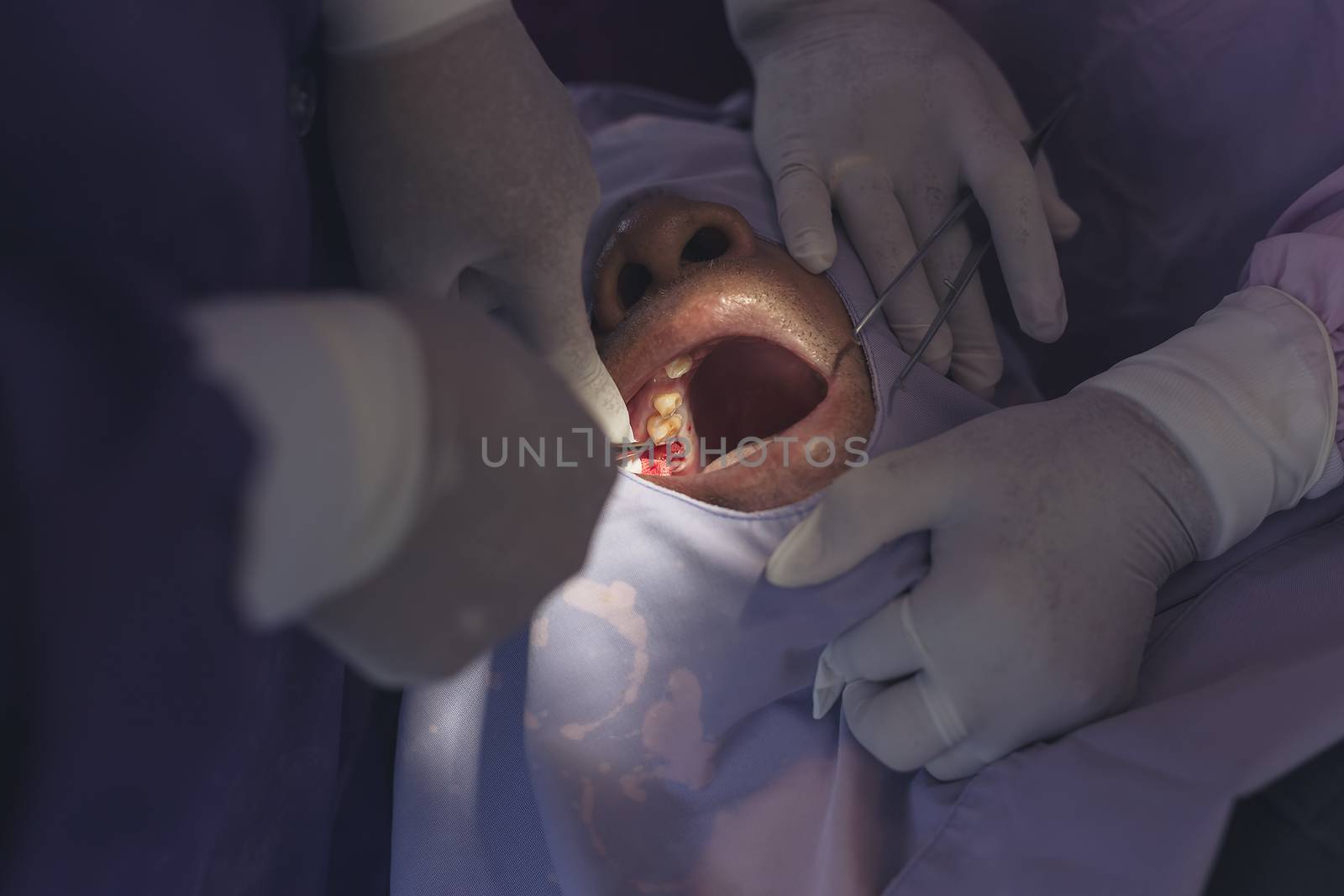 The dentist is removing the decaying tooth from the young man's mouth.