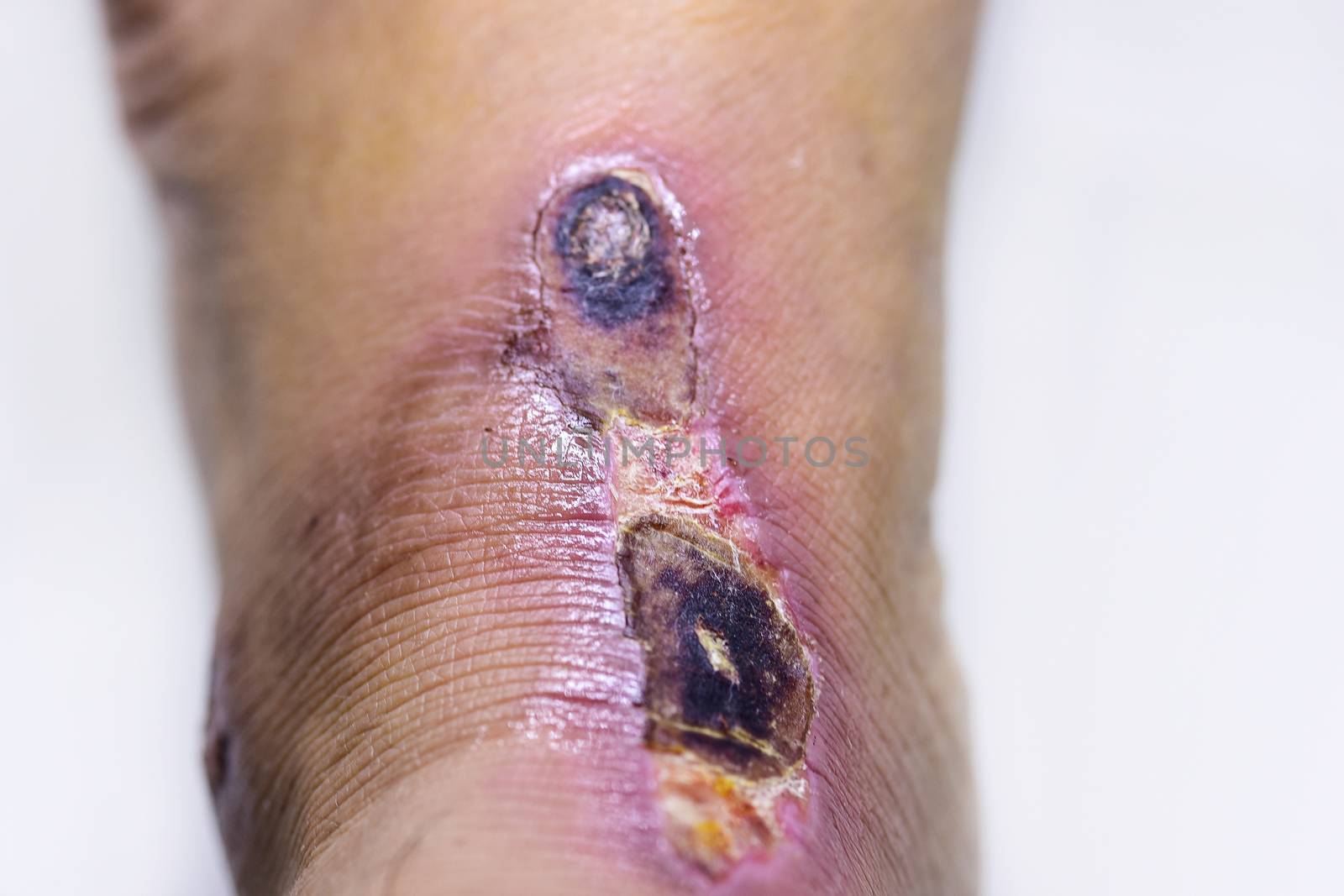 Closeup of blisters scab on man foot. by NuwatPhoto