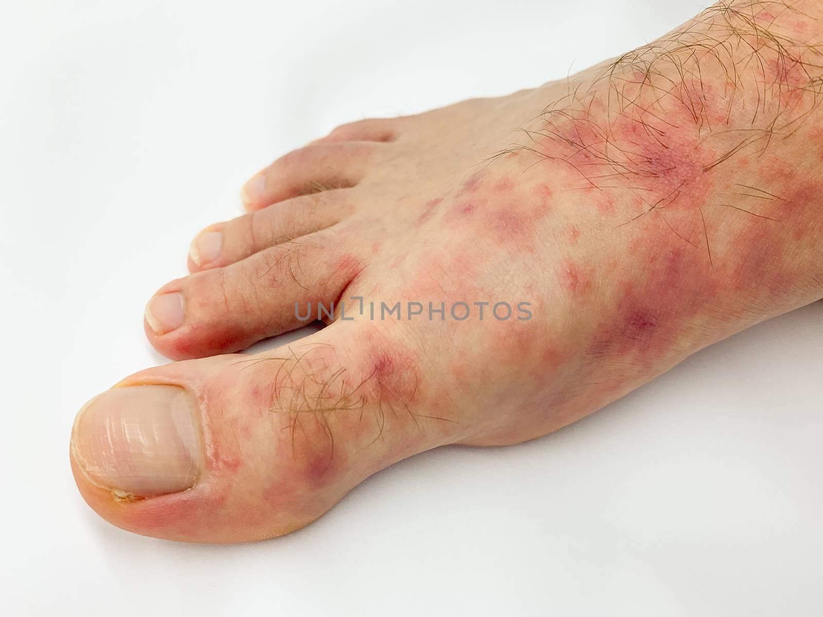 Close up of male's foot and toes with red rash desease on a white background. Stock image.