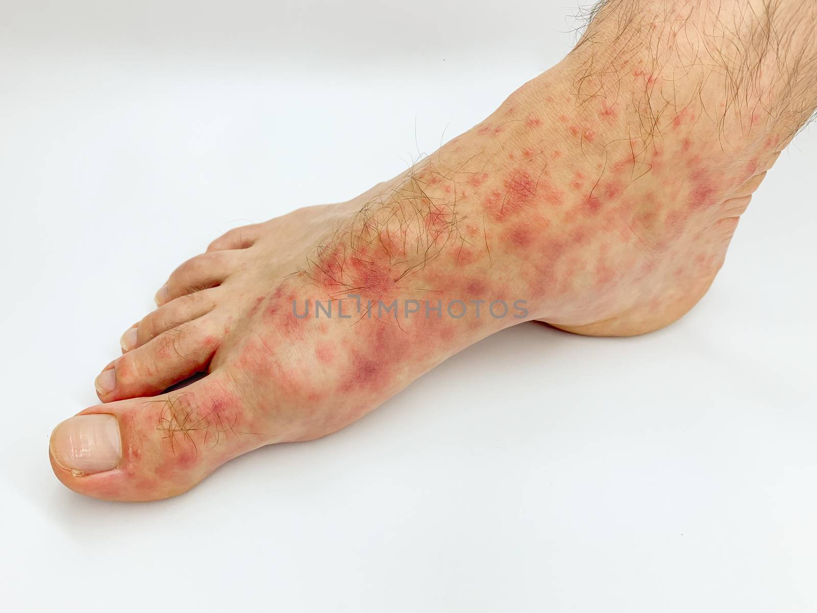 Close up of male's foot and toes with red rash desease on a white background. Stock image.