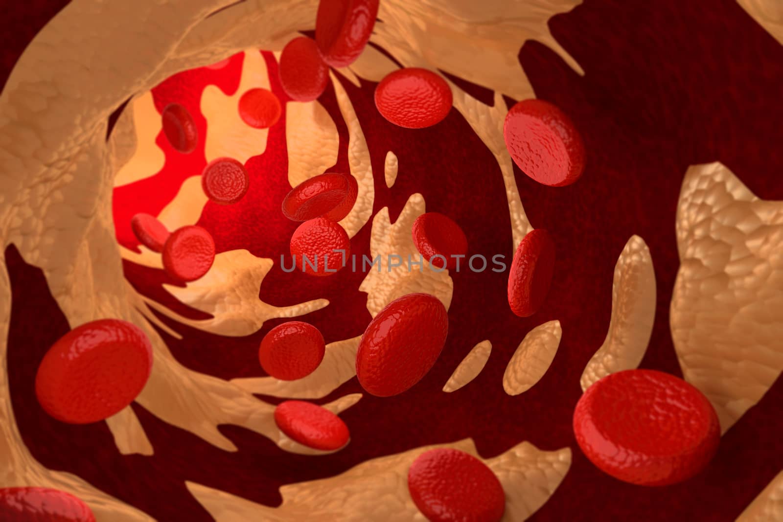3D rendering of arteriosclerosis by cholesterol plaque.