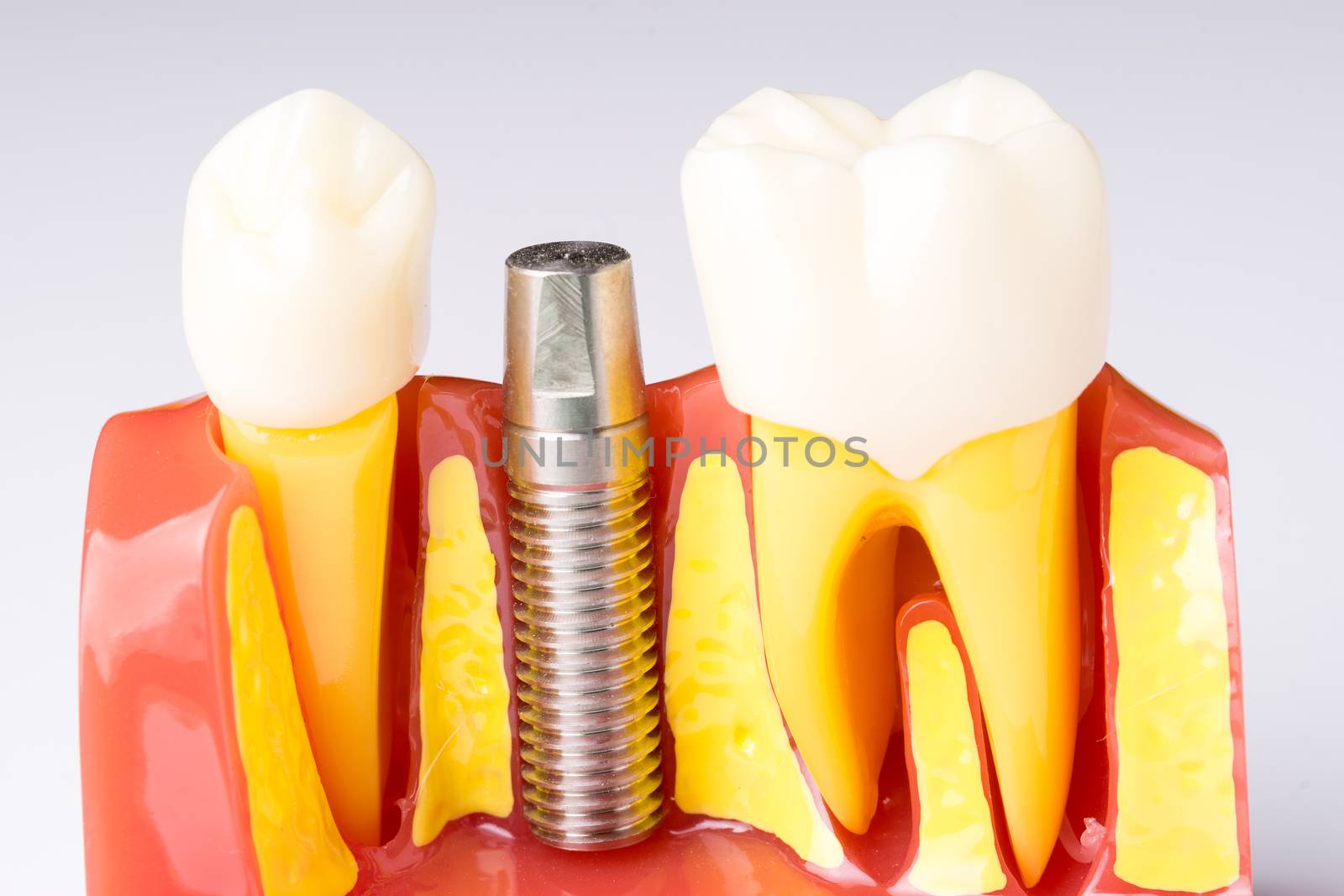 Set of Dentist's equipment tools, denture showing implant by Alicephoto