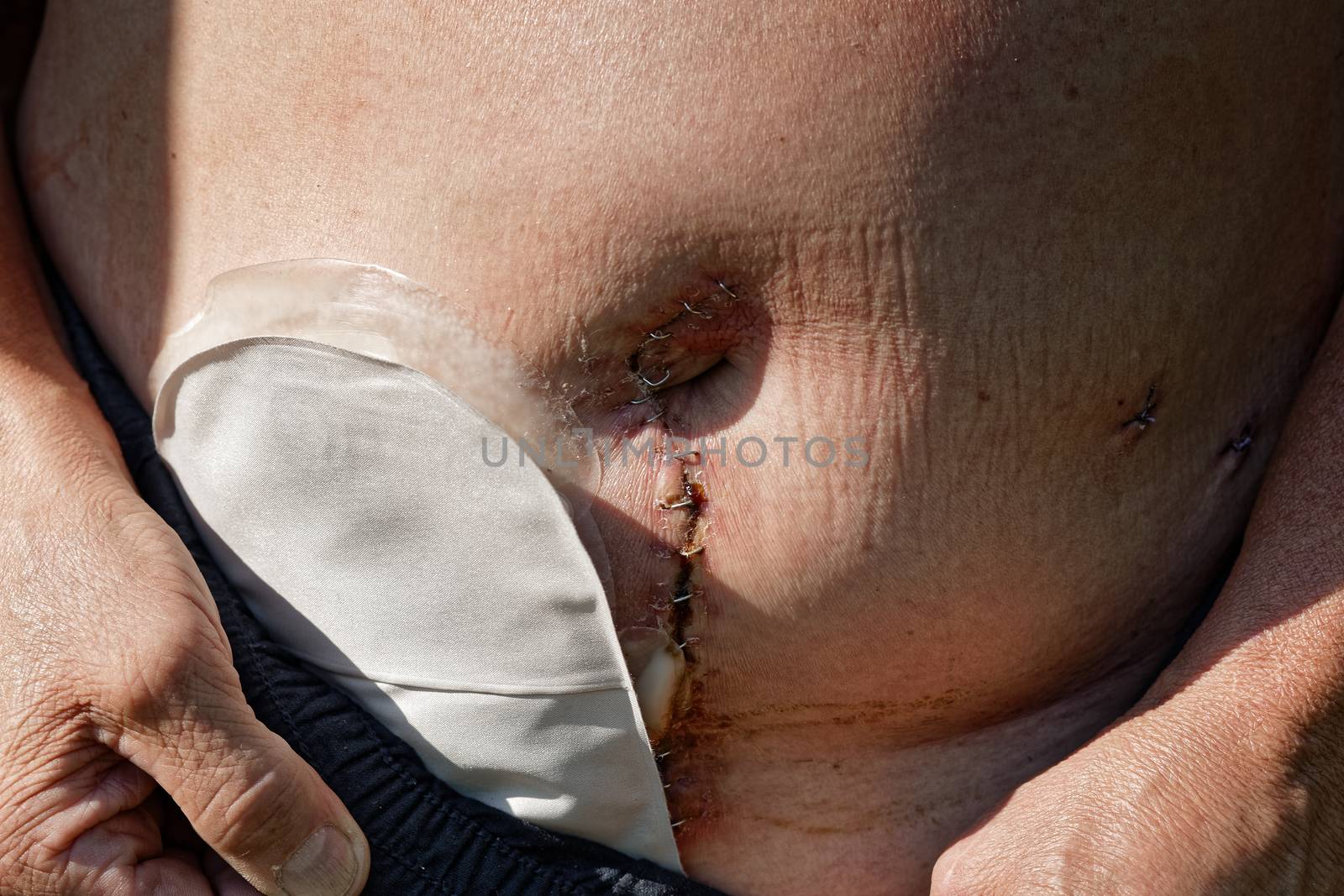 Adult caucasian man with temporary stoma by claraveritas