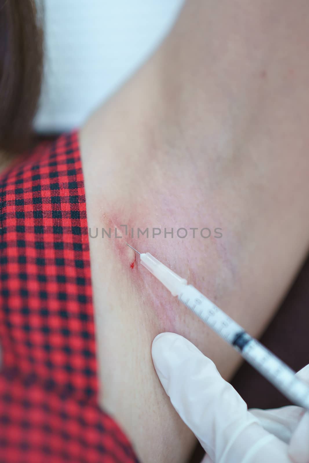 Closeup doctor injection treatment for keloids on the armpit.