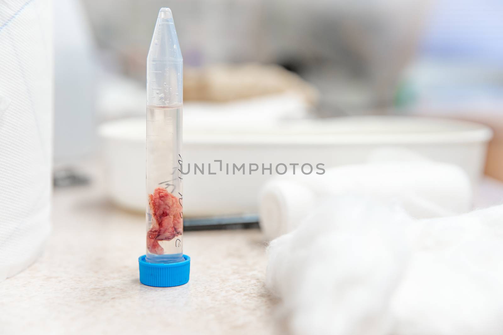 a tissue sample from the tumor to be sent for histological expertise.