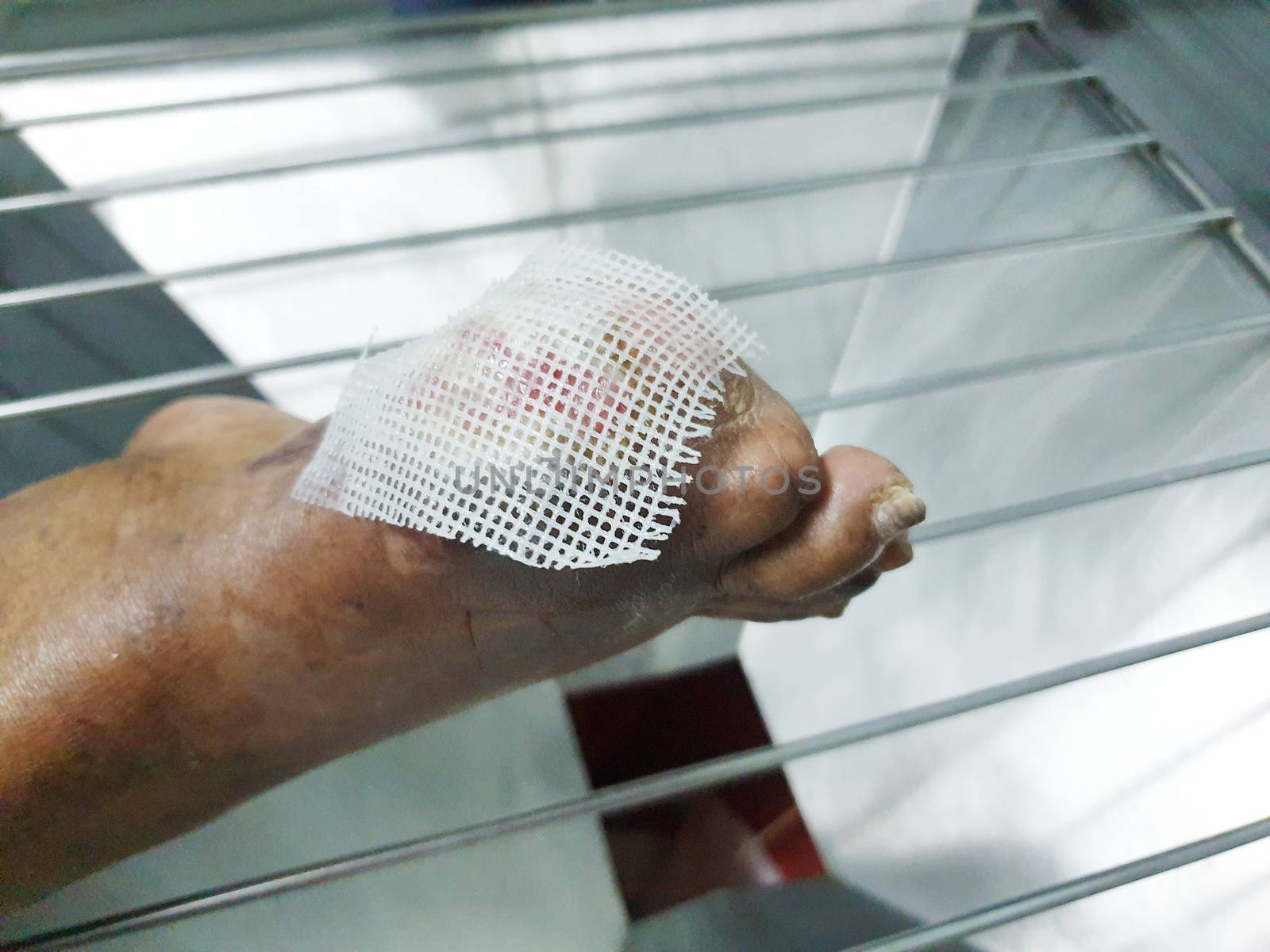 Patient healing wounds injury to tissue caused by diabetes mellitus on patient bed in intensive care unit (ICU.) room at hospital.