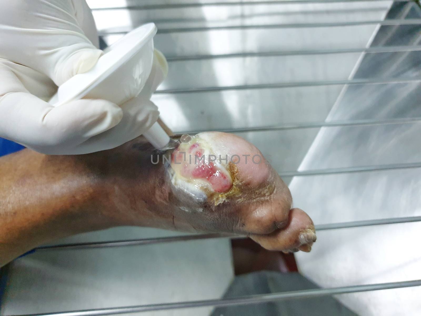 Patient healing wounds injury to tissue caused by diabetes mellitus on patient bed in intensive care unit (ICU.) room at hospital.