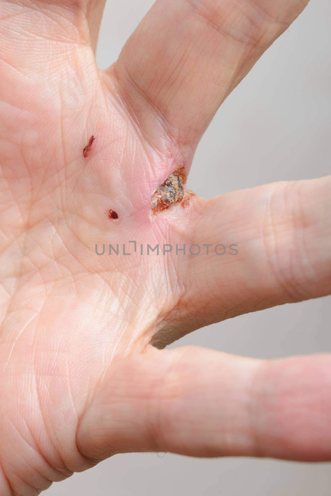 Man injured by dog bites in the hand. The deep wound left by the fangs between the fingers are obvious.