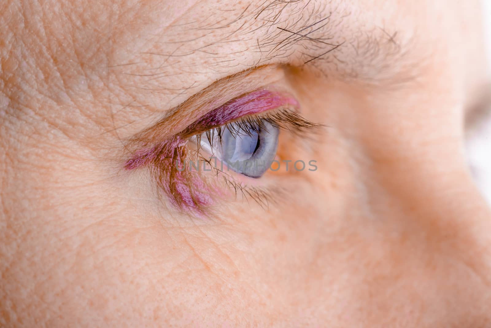 Injured eye due to capillary rupture by MaxalTamor