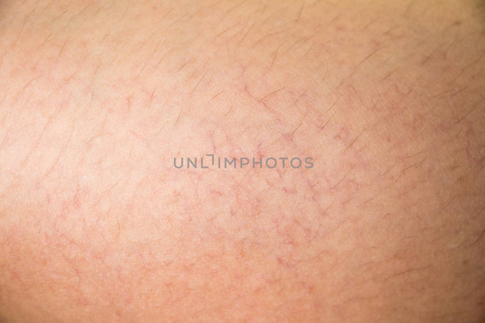 Closed up of vericose veins on female leg background