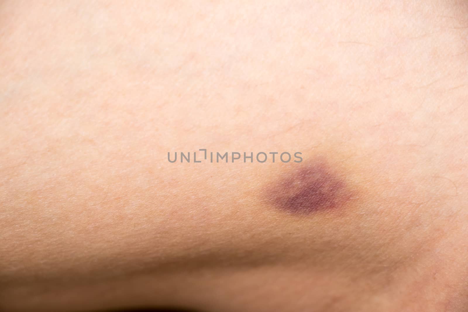 Closed up of bruised injury on woman leg background