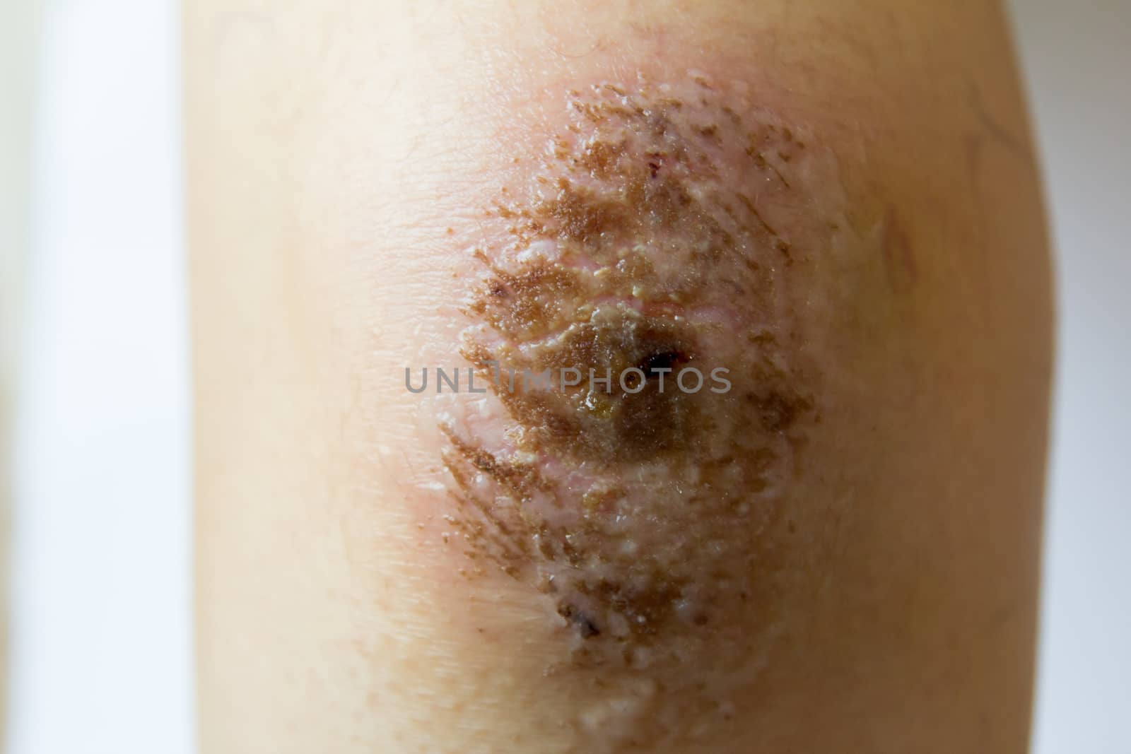 Closed up of red scab injury on woman knee background by Hengpattanapong