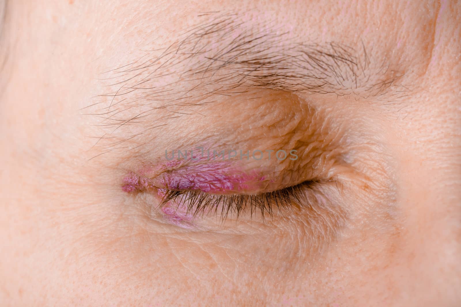 Injured eye due to capillary rupture by MaxalTamor