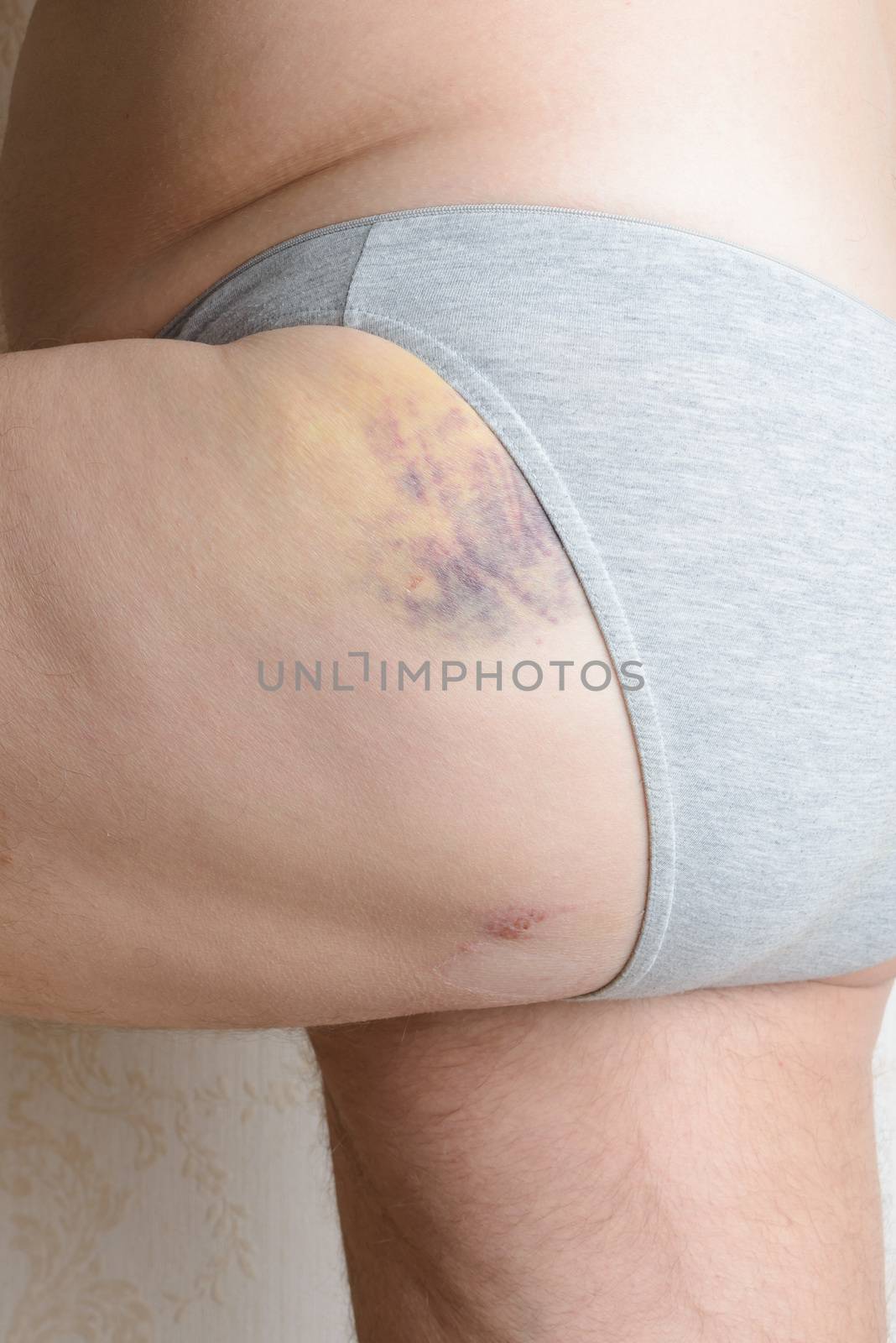 Man injured by dog bites in the buttock. The deep wounds left by the fangs are obvious. A blue hematoma covers the leg