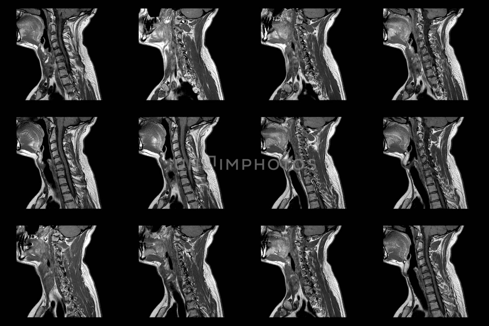 set of sagittal MRI scans of neck area of caucasian male with herniaset of MRI scans of neck area of caucasian male with bilateral paramedial, with a left accent, extrusion of the C6-C7 segment with left-sided C7 radiculopathy, moderate paresis of the triceps of the left hand.