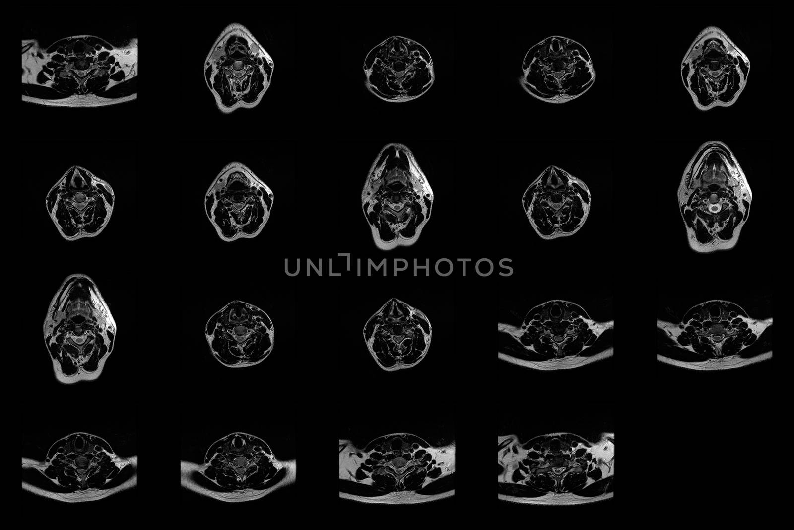 set of transverse MRI scans of neck area of caucasian male with herniaset of MRI scans of neck area of caucasian male with bilateral paramedial, with a left accent, extrusion of the C6-C7 segment with left-sided C7 radiculopathy, moderate paresis of the triceps of the left hand.