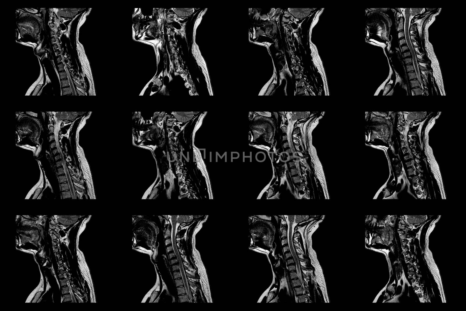 set of sagittal MRI scans of neck area of caucasian male with herniaset of MRI scans of neck area of caucasian male with bilateral paramedial, with a left accent, extrusion of the C6-C7 segment with left-sided C7 radiculopathy, moderate paresis of the triceps of the left hand.