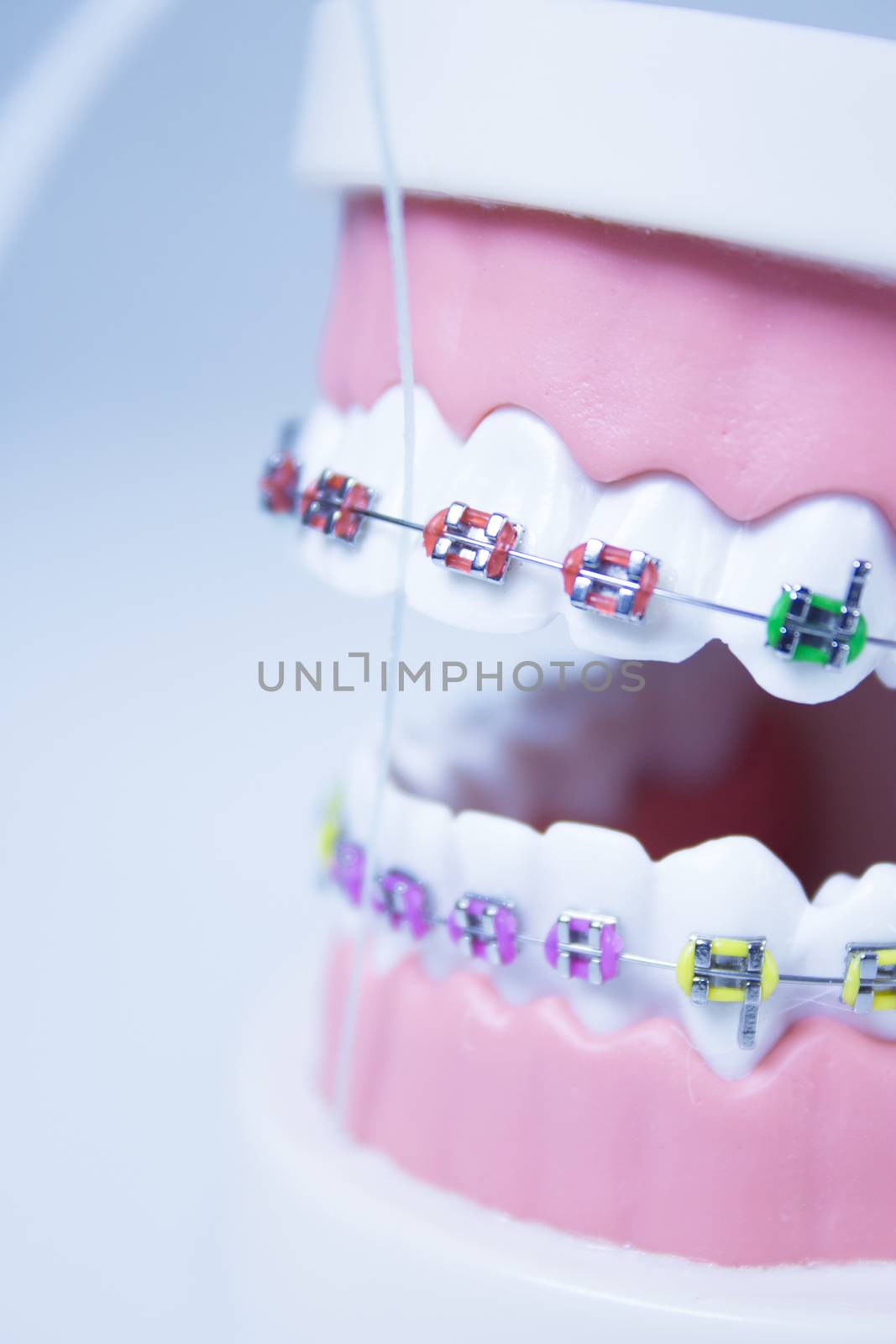 Model denture with metal orthodontics by GemaIbarra