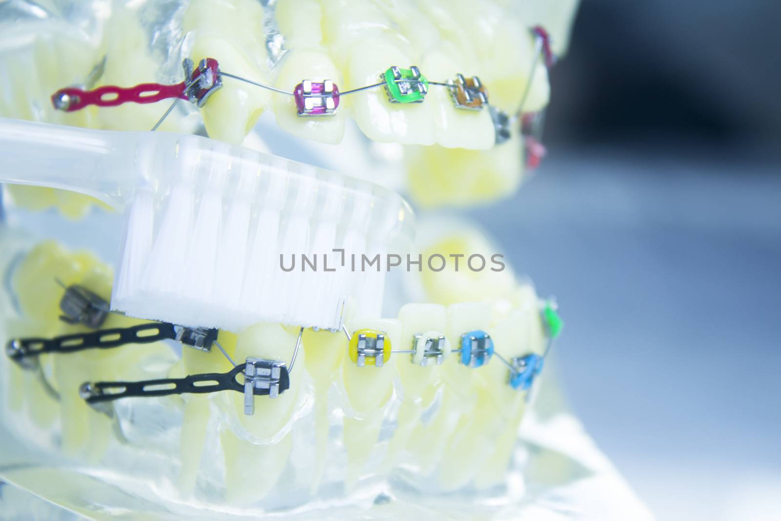 Model denture with metal orthodontics by GemaIbarra