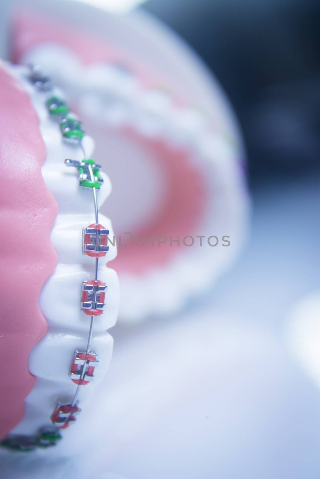 Model denture with metal orthodontics by GemaIbarra