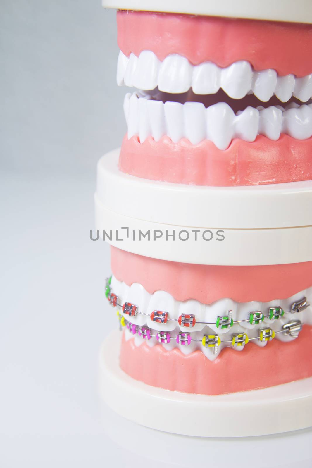 Model denture with metal orthodontics by GemaIbarra