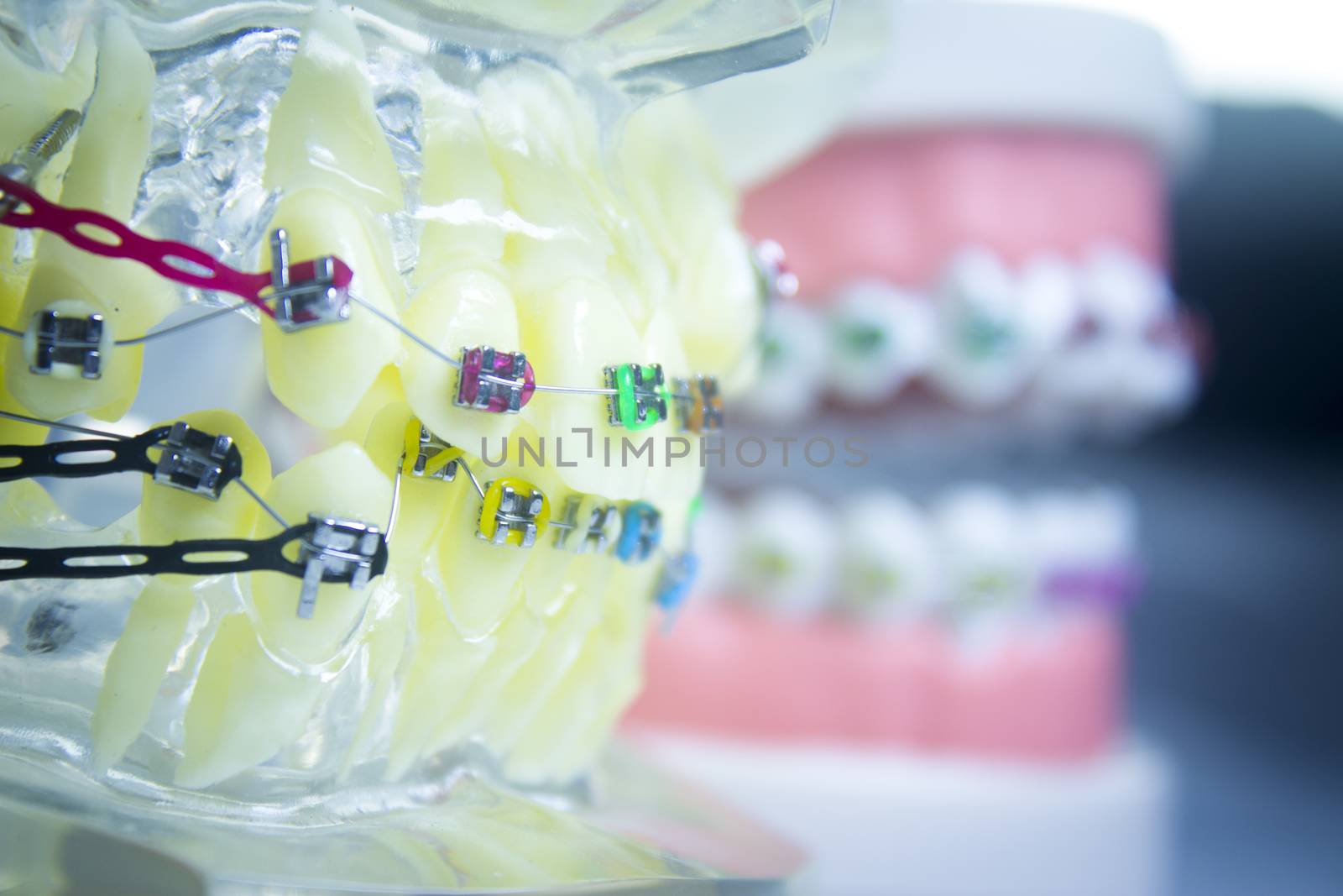 Model denture with metal orthodontics by GemaIbarra