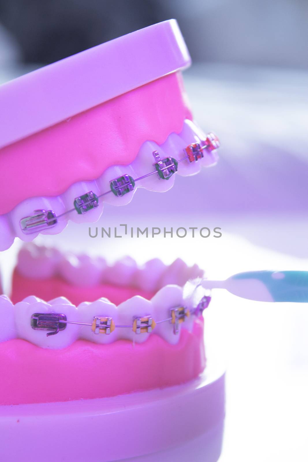 Model denture with metal orthodontics by GemaIbarra