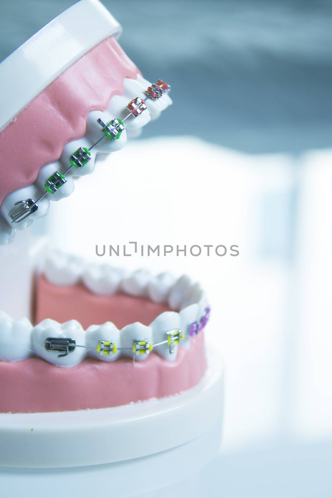 Model denture with metal orthodontics by GemaIbarra