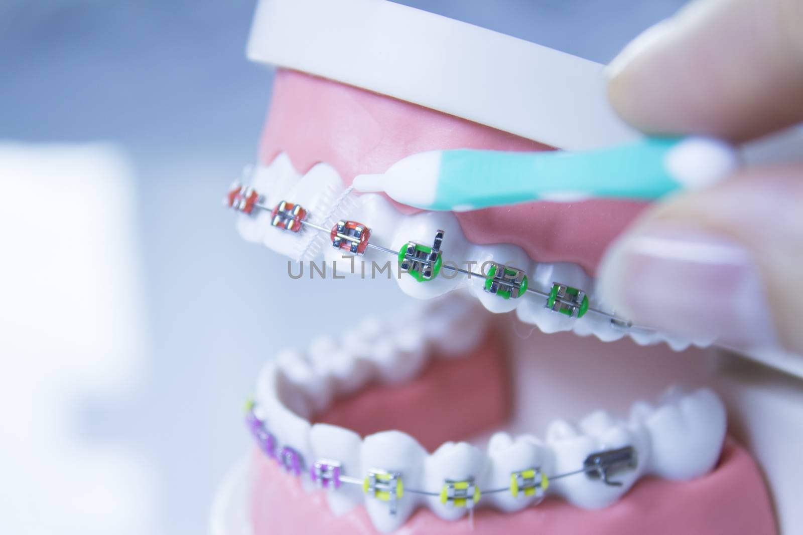 Model denture with metal orthodontics by GemaIbarra