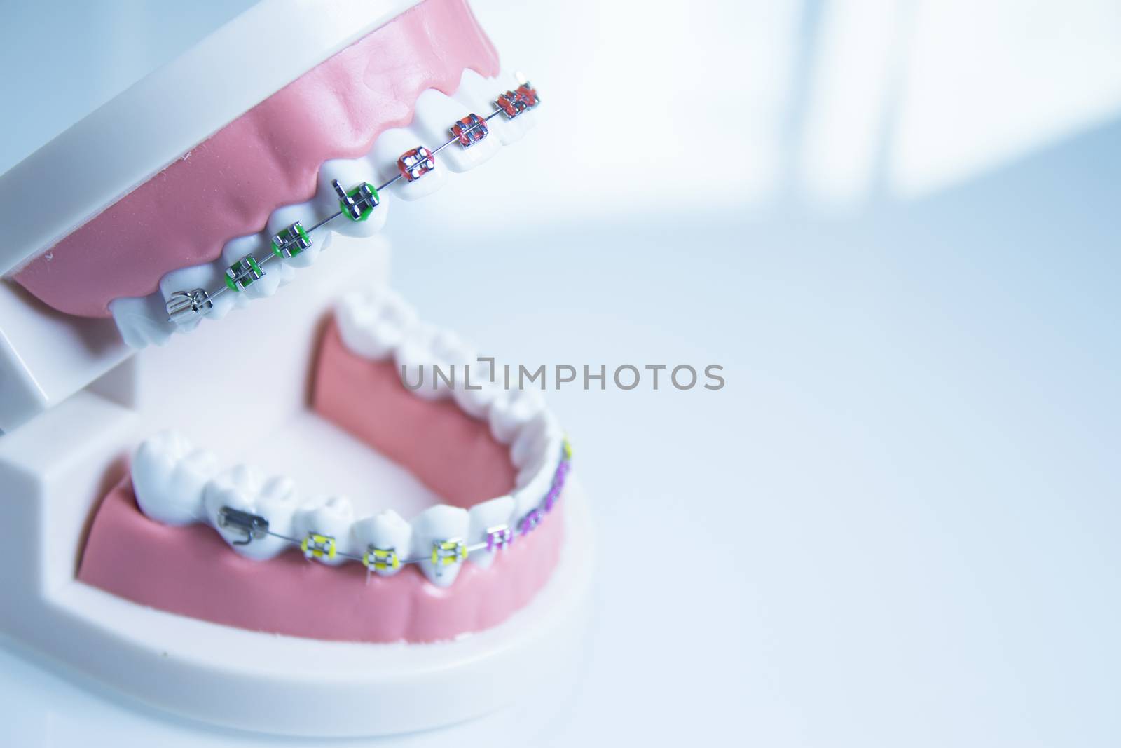 Model denture with metal orthodontics by GemaIbarra