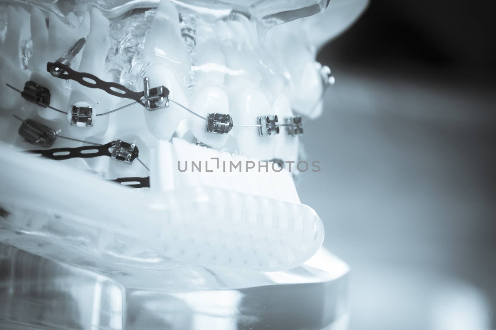 Model denture with metal orthodontics by GemaIbarra