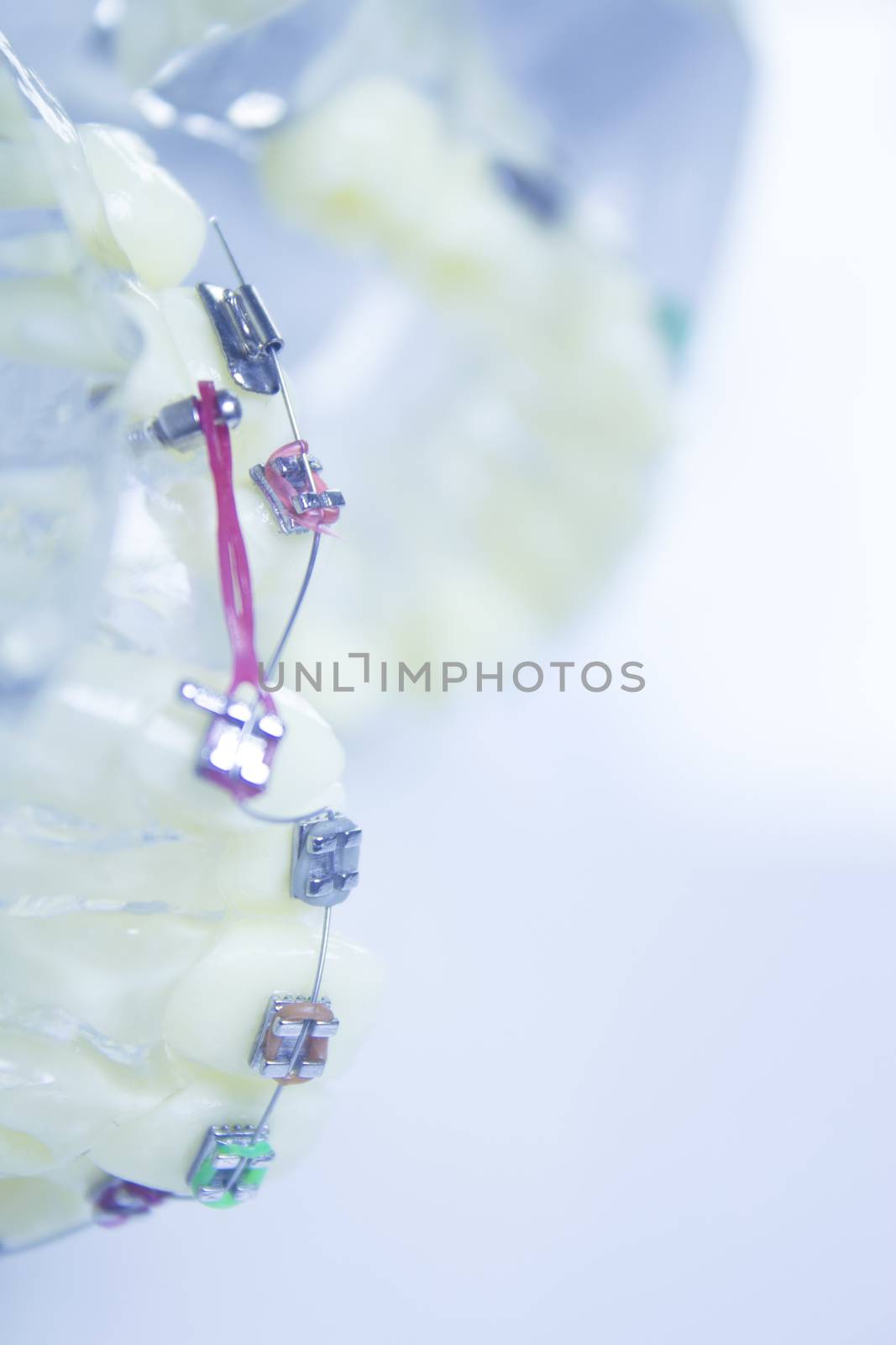 Model denture with metal orthodontics by GemaIbarra