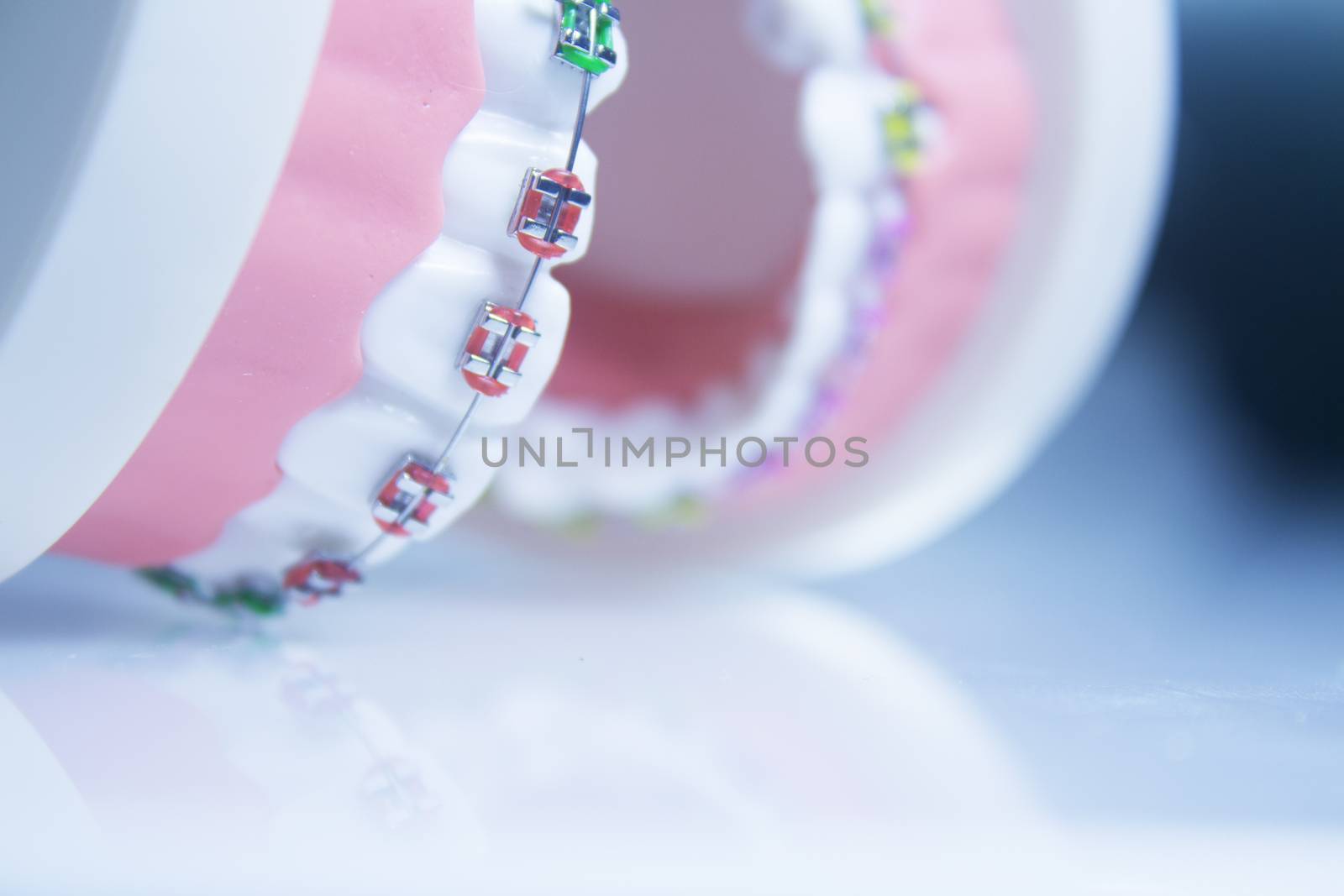 Model denture with metal orthodontics by GemaIbarra