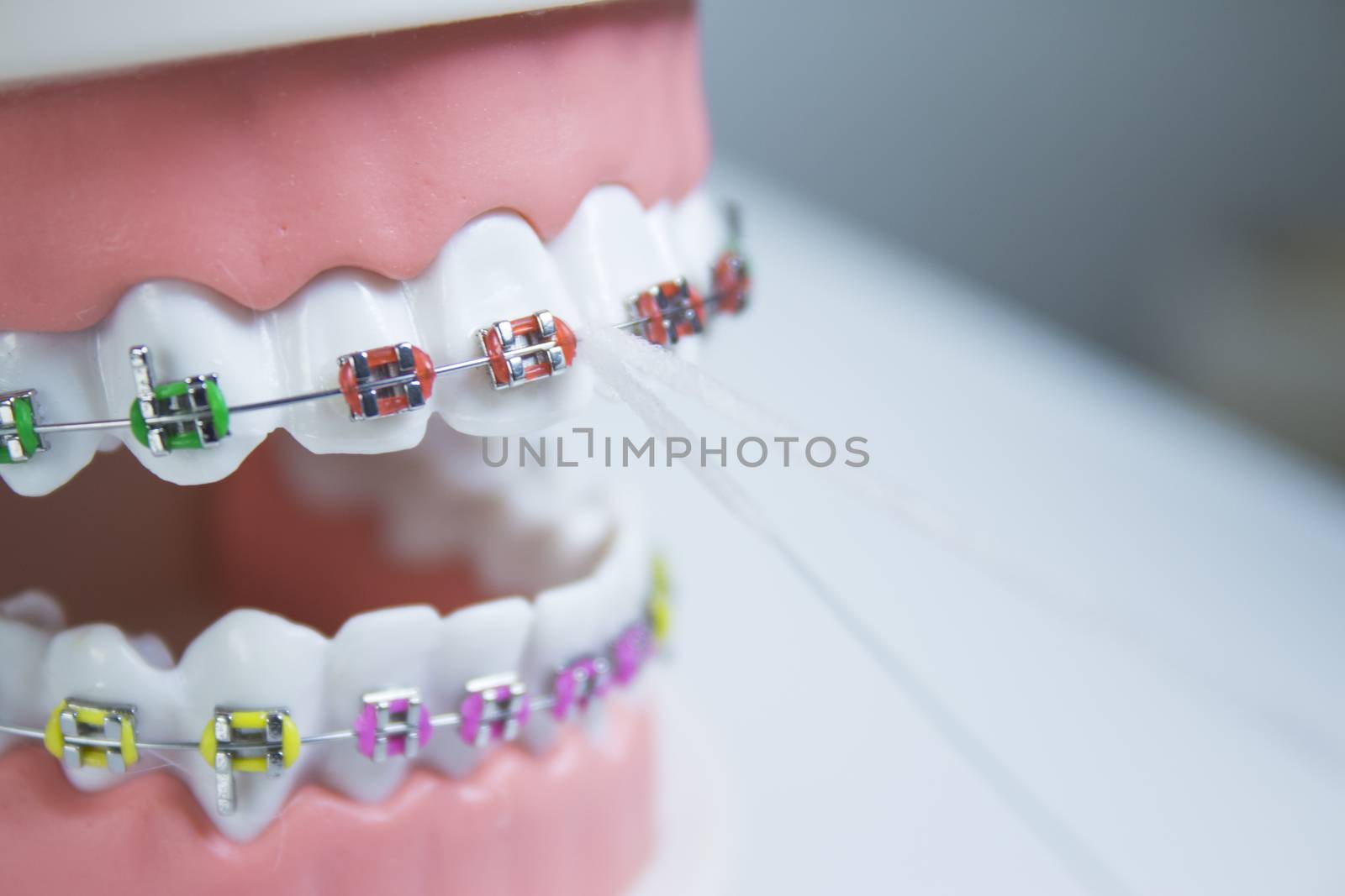 Model denture with metal orthodontics by GemaIbarra