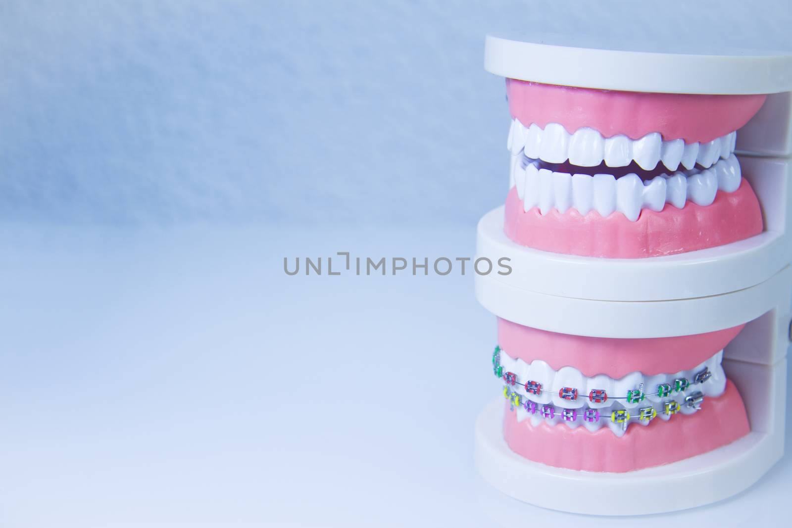 Model denture with metal orthodontics by GemaIbarra