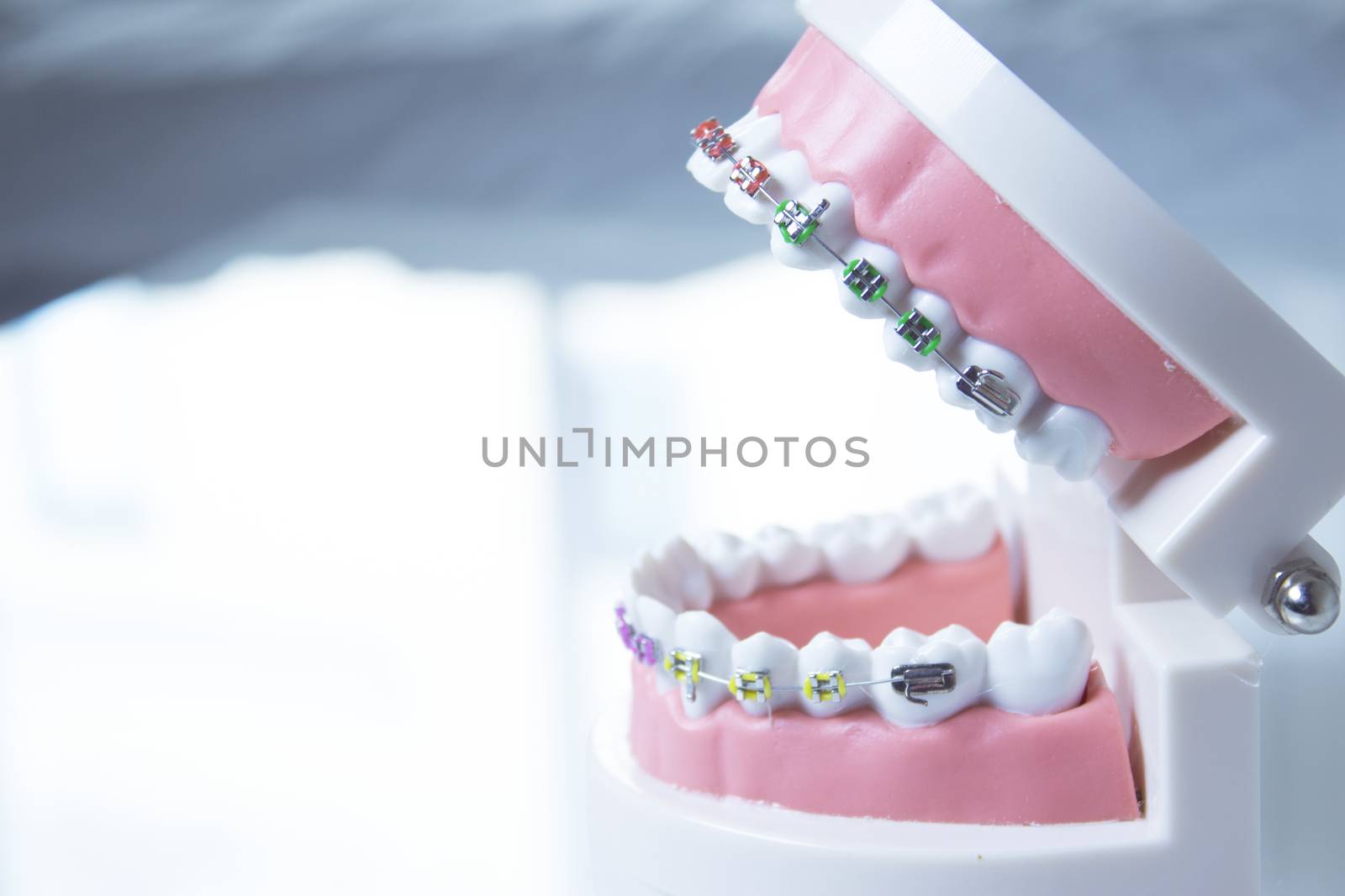 Model denture with metal orthodontics by GemaIbarra