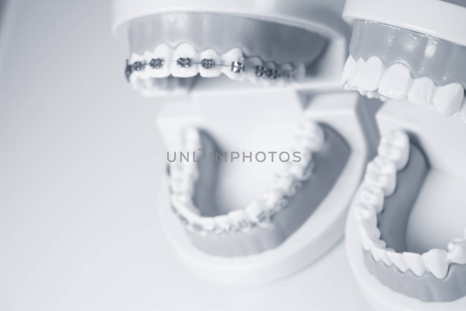 Model denture with metal orthodontics. No people
