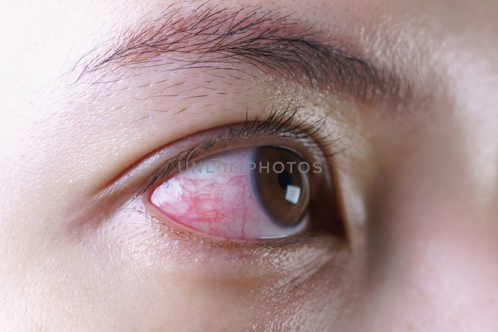 Red bloodshot eye of woman, irritated or infected, conjunctivitis eye or after cry.