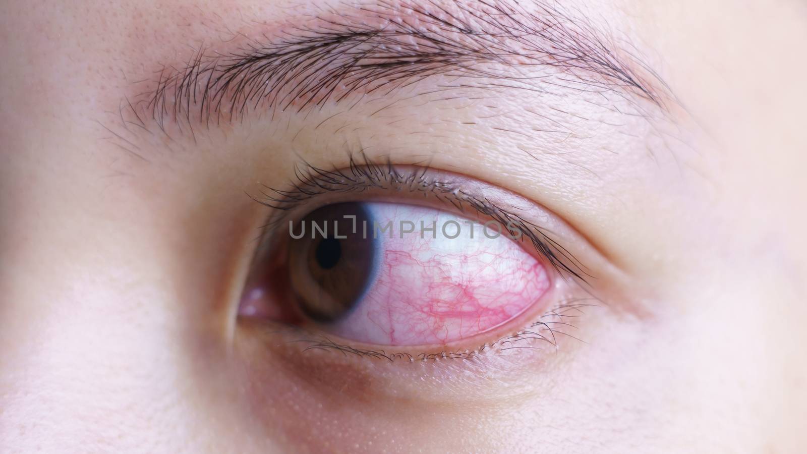 Red bloodshot eye of woman, irritated or infected, conjunctivitis eye or after cry.