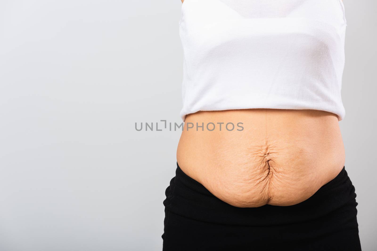 woman showing stretch mark loose lower abdomen skin she fat afte by Sorapop