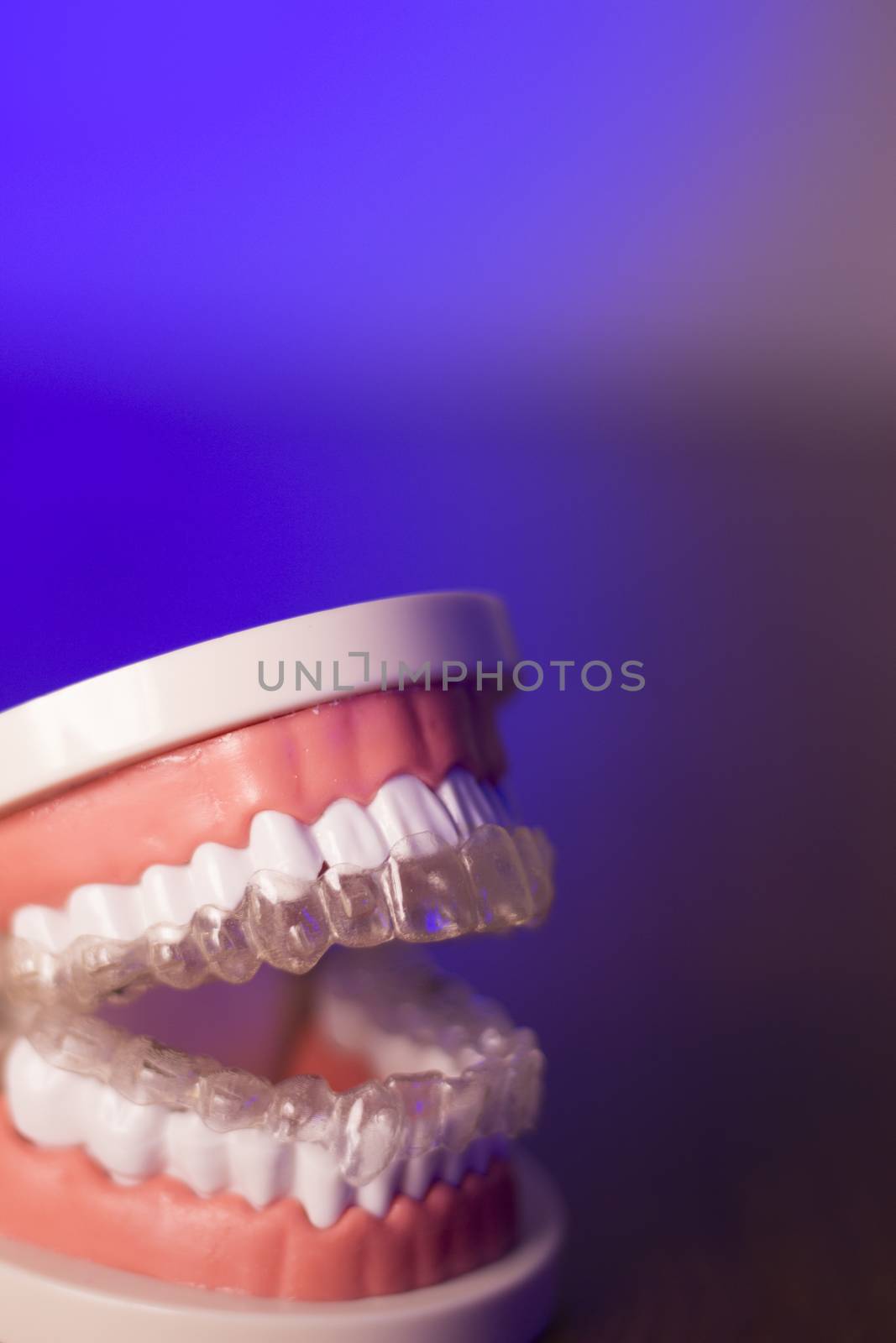 Denture with transparent orthodontics by GemaIbarra