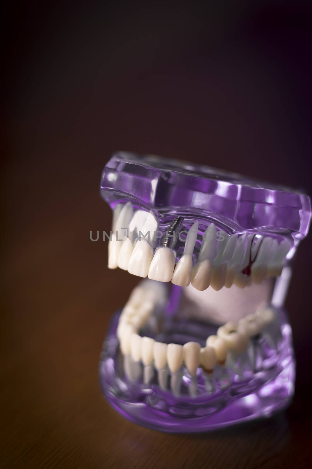 Denture for dentistry students by GemaIbarra