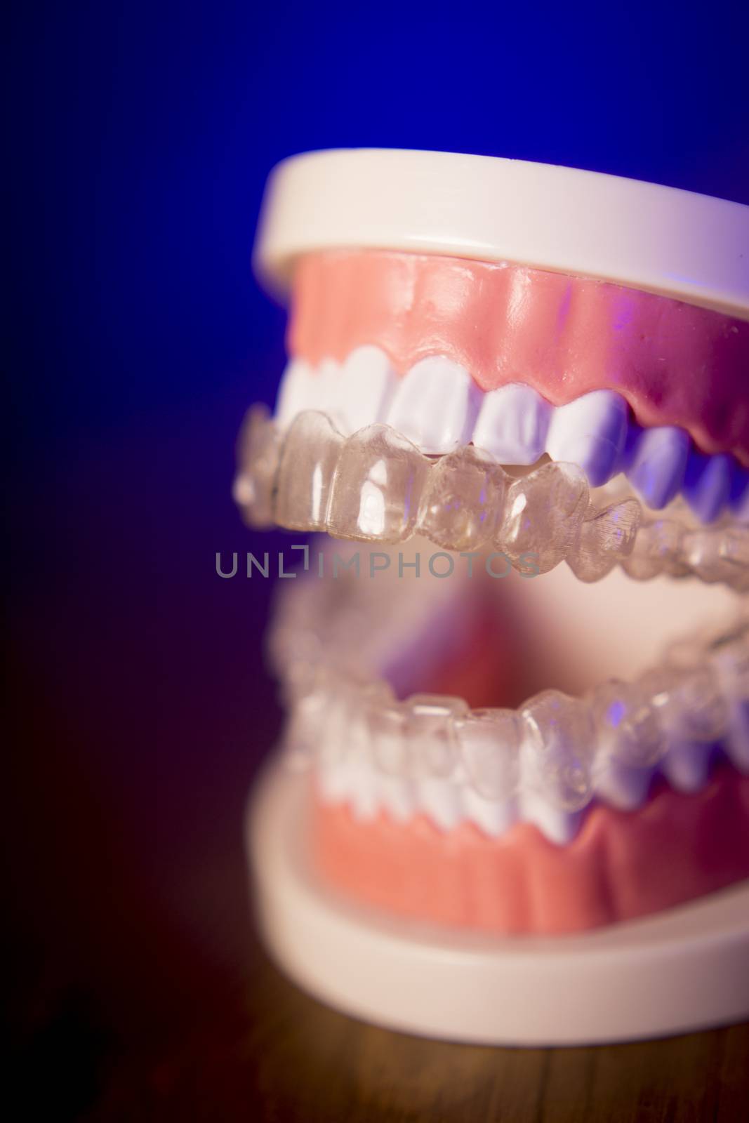 Denture with transparent orthodontics by GemaIbarra