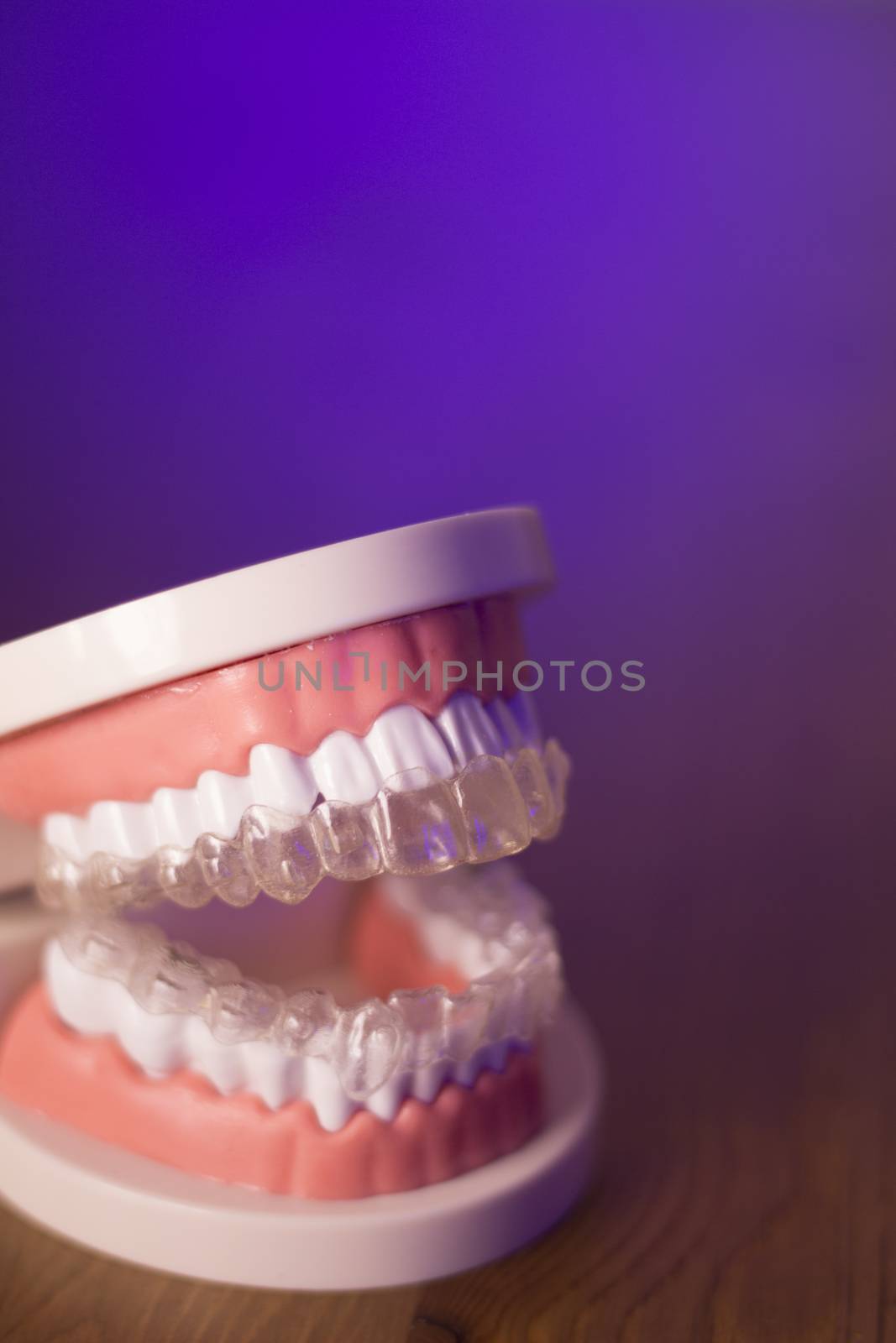 Denture with transparent orthodontics by GemaIbarra