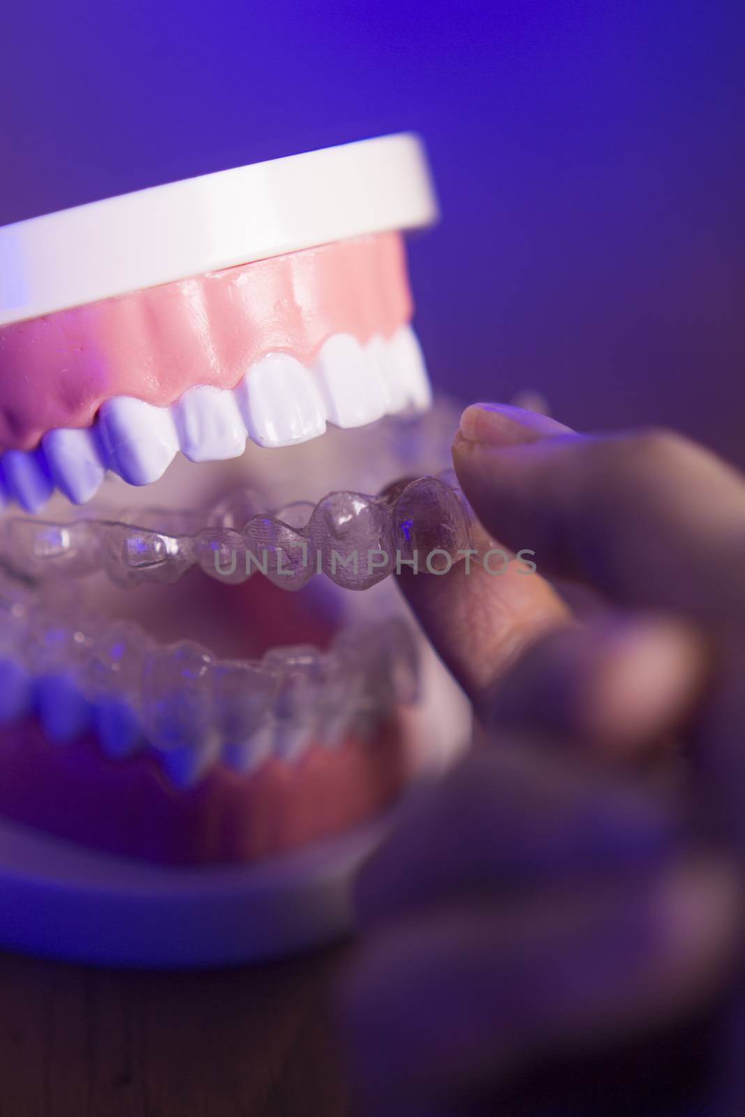 Denture with transparent orthodontics by GemaIbarra