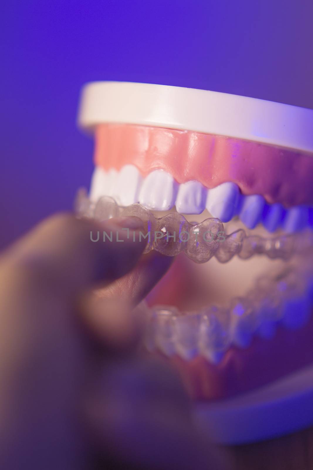 Denture with transparent orthodontics by GemaIbarra