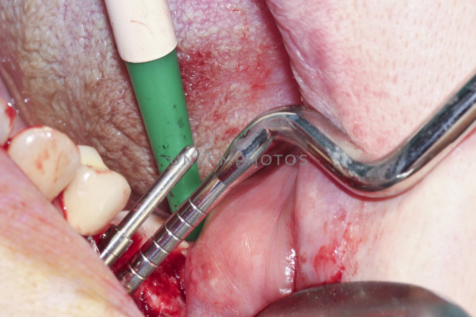 Surgical operation on the molars. Dental Implant by GemaIbarra