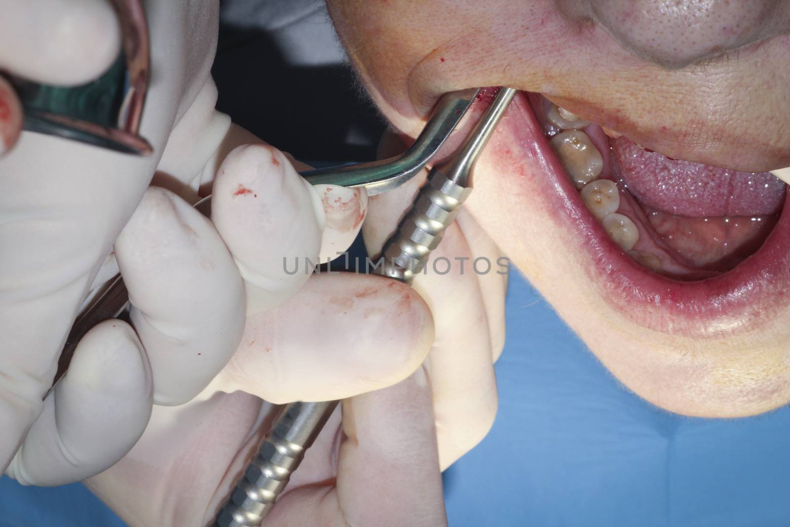 Surgical operation on the molars. Dental Implant by GemaIbarra