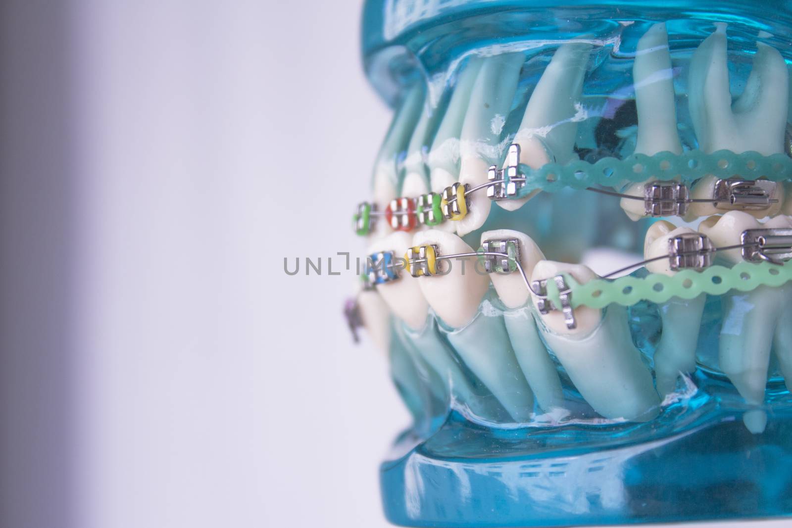 Denture for students with classic dental metal orthodontics. Color aesthetic couplings.