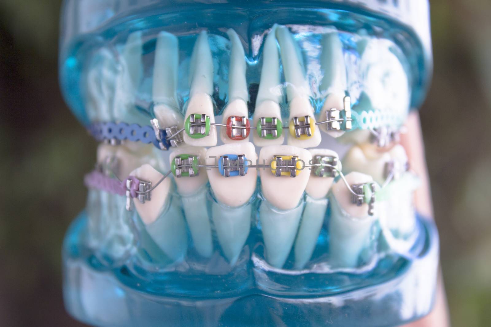 Denture for students with classic dental metal orthodontics. Color aesthetic couplings.